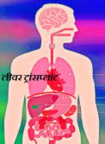 लीवर ट्रांसप्लांट